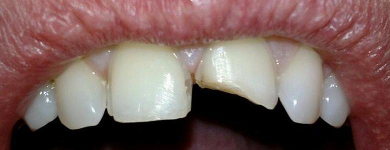 Dual_Arc_Dental_Front_Teeth 1